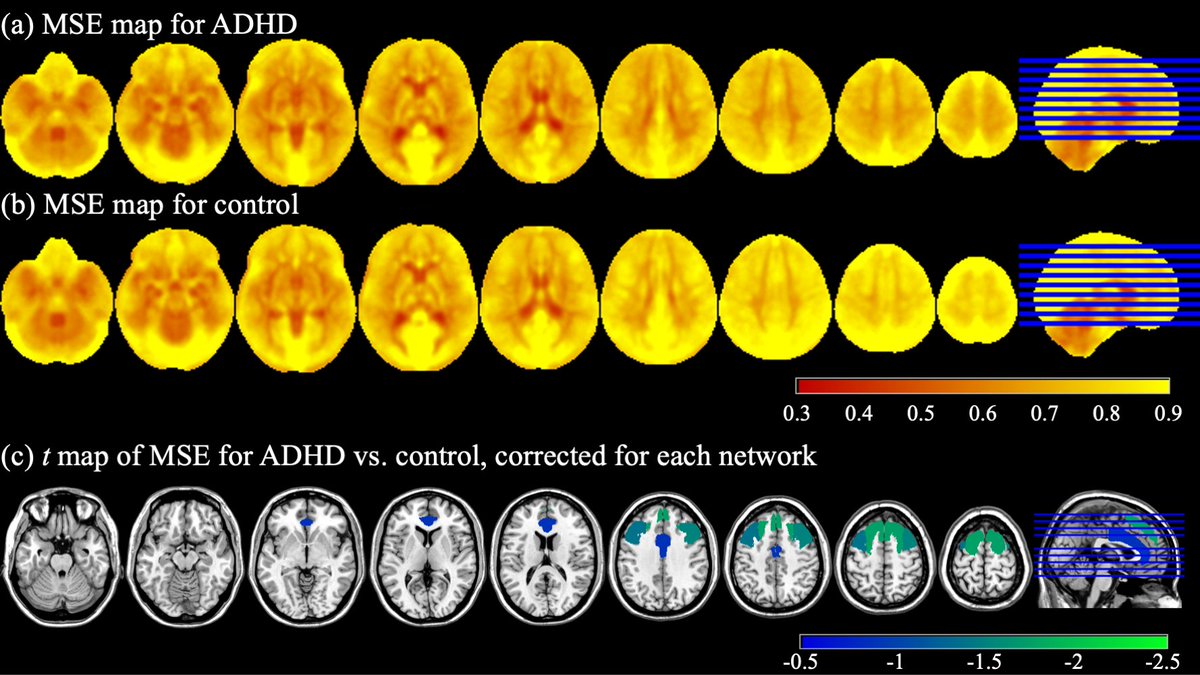 🎉 Congrats to Ru Zhang for her new publication in Psychiatry Research: Functional connectivity and complexity analyses of resting-state fMRI in pre-adolescents demonstrating the behavioral symptoms of ADHD 👉 bit.ly/49FhdWI