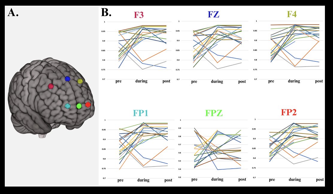 NaomiGaggi's tweet photo. I'm beyond thrilled to share my latest findings published in @brainstimj on the effects of transcranial photobiomodulation on intrinsic brain activity in early Alzheimer's Disease 🧠: https://t.co/DOI9JBzCAZ #tpbm #Alzheimers https://t.co/RQ2Y1k9PDj