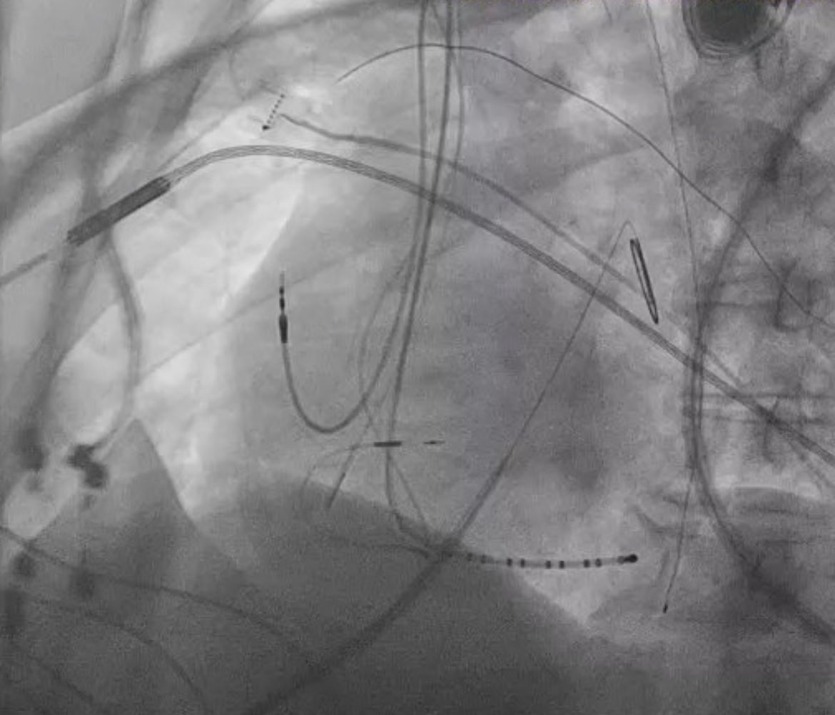 LAO view of transhepatic transseptal access for AF ablation. #EPeeps