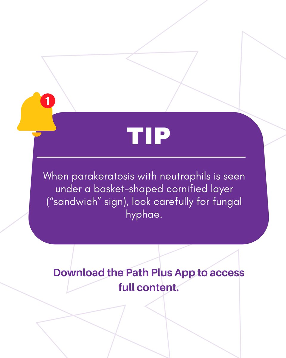 MDplusApp's tweet photo. ⚠️Tips and Pitfalls Alerts 
🔬Psoriasiform dermatitis
🎯Skin

Download now: https://t.co/mWiGI2pkMG 

#pathplus #pathology #pathologic https://t.co/qEUQTWpFwJ