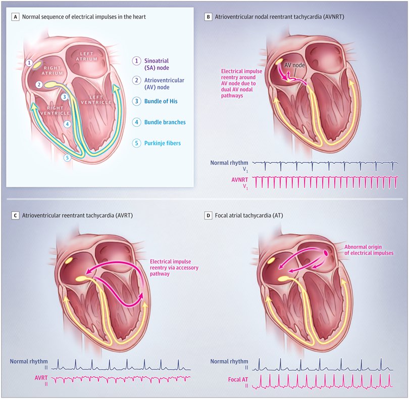 SeguraCardio's tweet photo. ⚠️Diagnosis &amp; Management of Paroxysmal Supraventricular Tachycardia‼️

Excellent #Review at @JAMA_current 

#CardioTwitter #Epeeps https://t.co/NCI79ifRhs