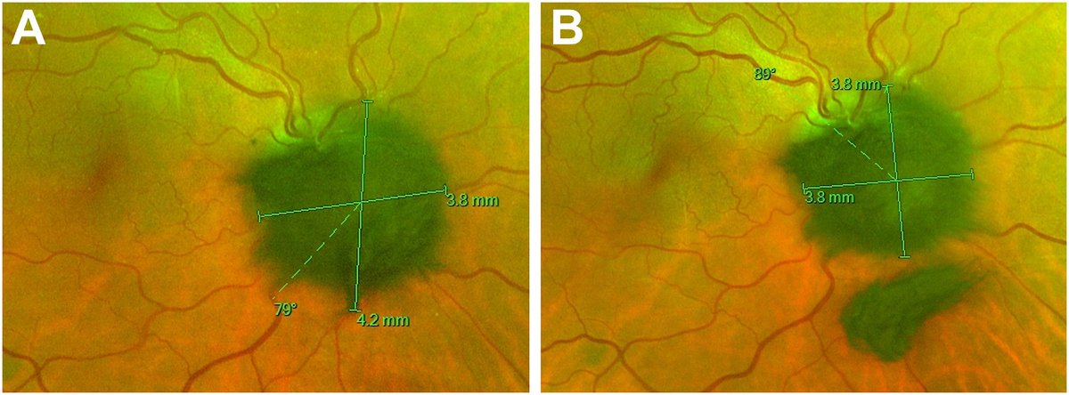 Michael Balas (@themichaelbalas) on Twitter photo Check out our remarkable case of an optic disc melanocytoma that appeared to shrink after a posterior vitreous detachment! 🧐👁️
<a href="/AAOjournal/">Ophthalmology</a>
authors.elsevier.com/a/1icGcamCtQzns Check out our remarkable case of an optic disc melanocytoma that appeared to shrink after a posterior vitreous detachment! 🧐👁️
<a href="/AAOjournal/">Ophthalmology</a>
authors.elsevier.com/a/1icGcamCtQzns