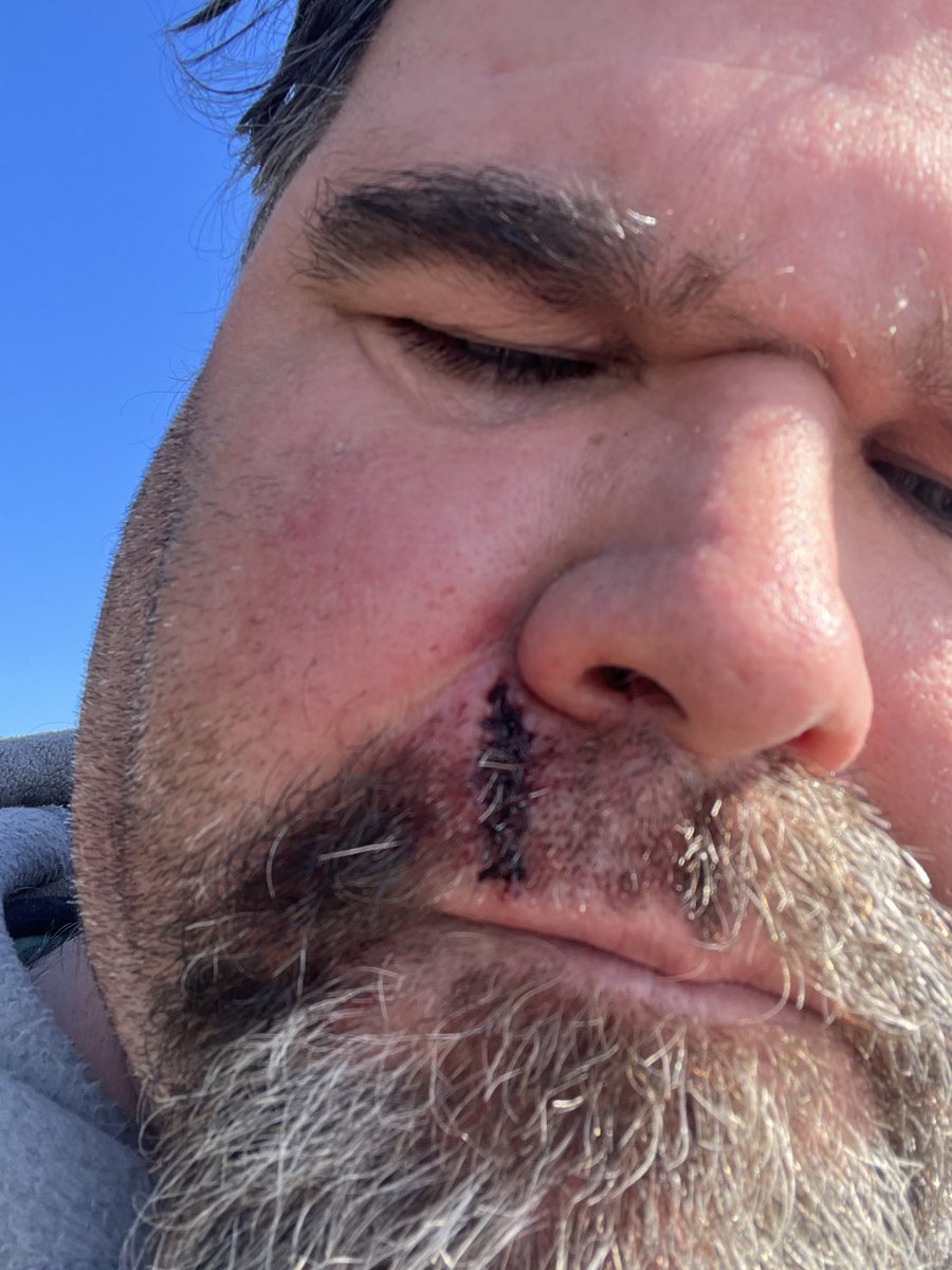 Herring the puck hit u face before u feel it is never a good thing