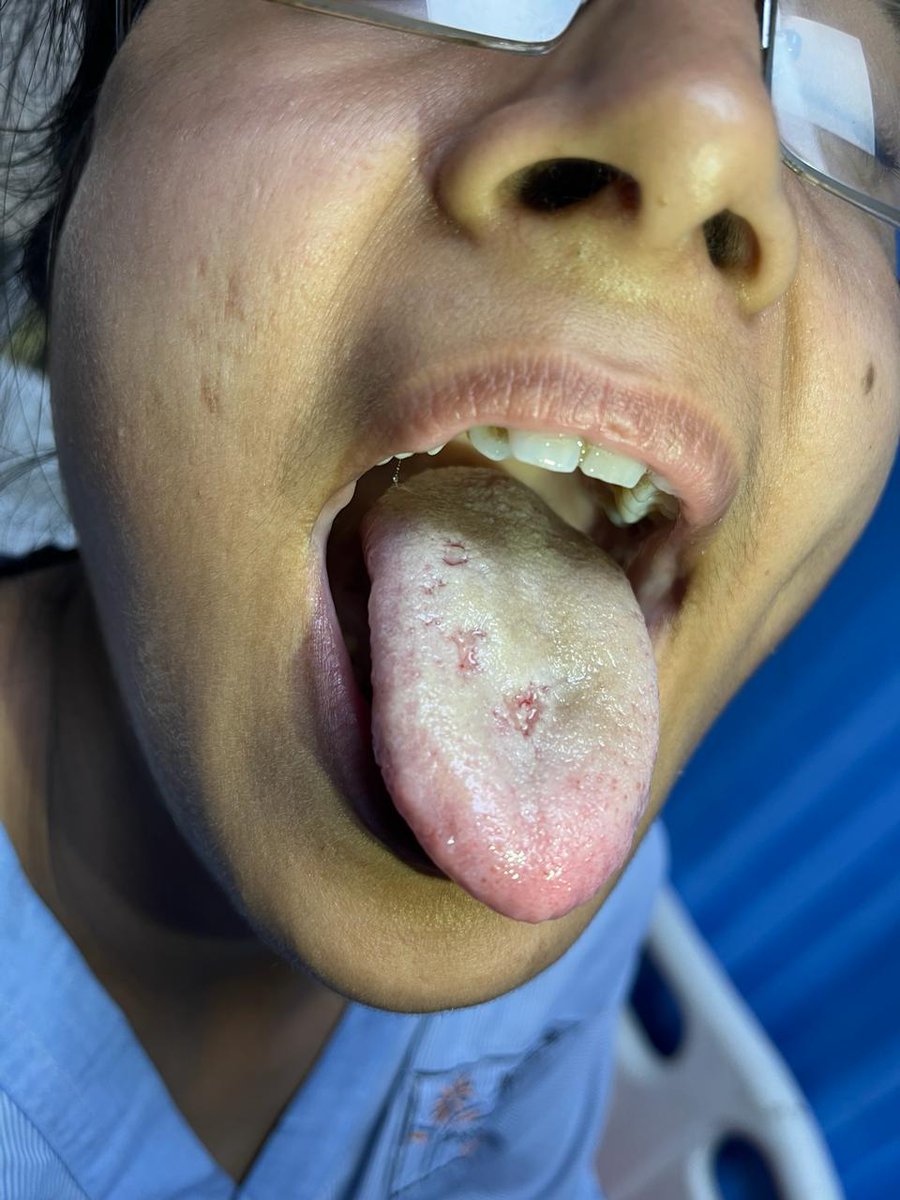 sandeepnephro's tweet photo. Vasculitic ulcer on the tongue in a case of GPA https://t.co/4ZP7k5Is0s
