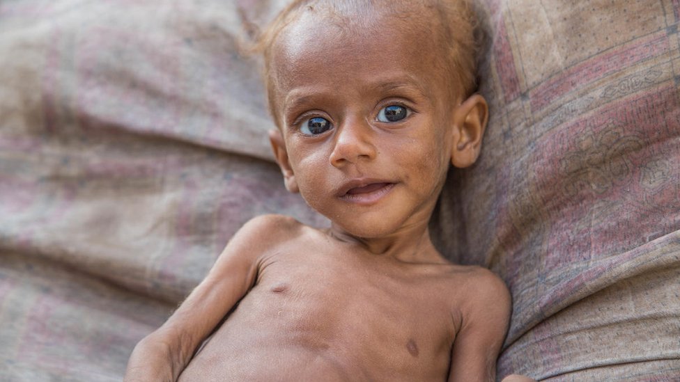 p_inc_p's tweet photo. Hey #DisgustingBBC: this little boy (from Yemen)👇 is malnourished. This little girl (from #Gaza)👇 isn't. By lying about #Gaza to satisfy its antisemitic impulses, @BBC @BBCWorld tries to hurt #Israel; but they really hurt the children from Yemen. https://t.co/DquQLL5q4j