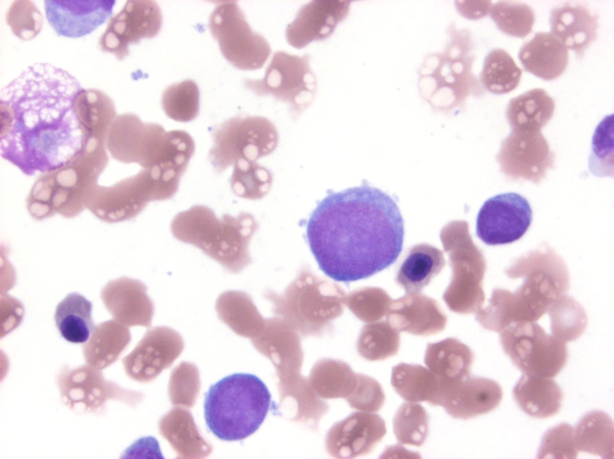 #hemepath megakaryoblasts. Bleb bleb bleb