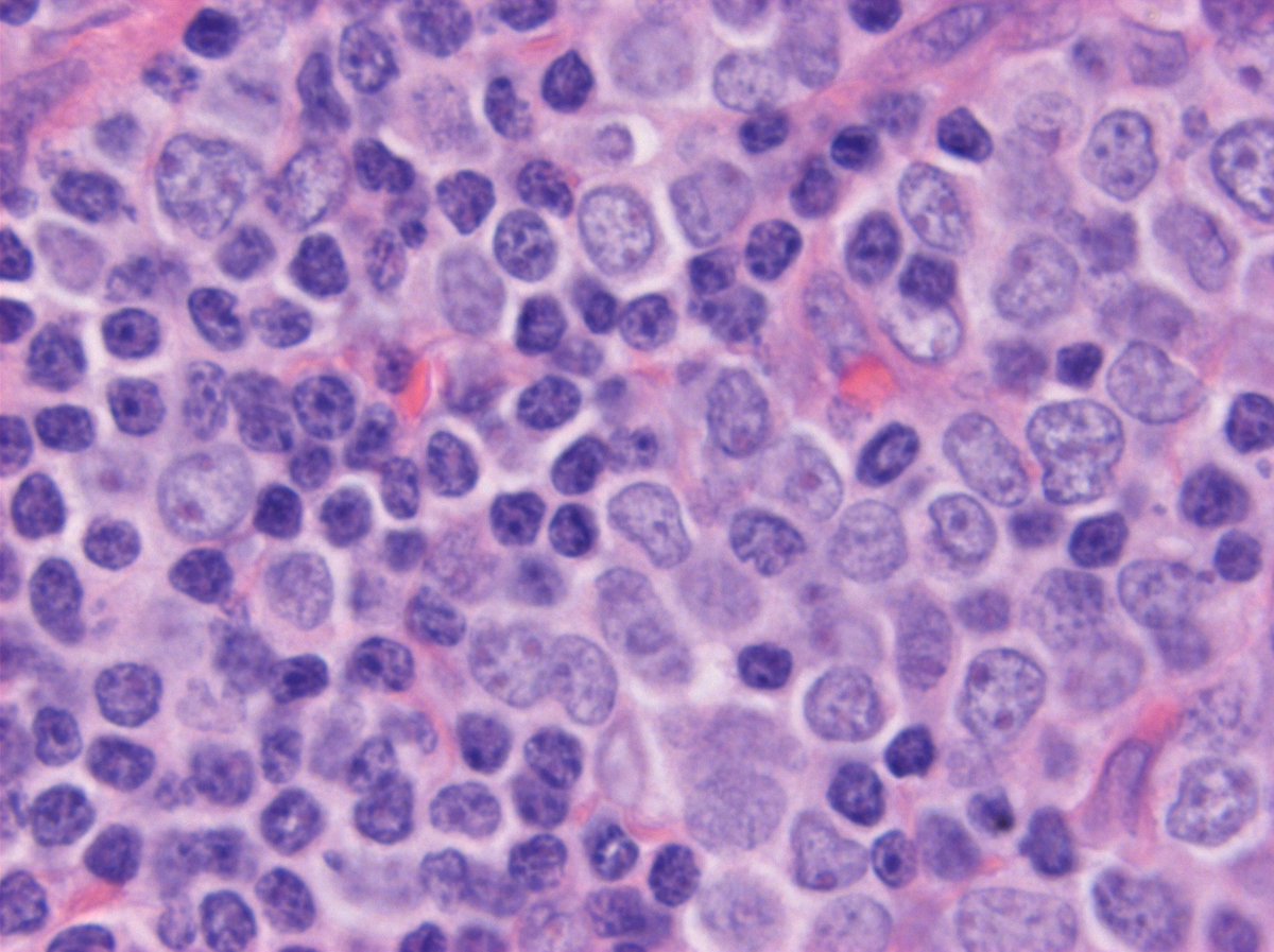 #hemepath comparison of B-ALL cells to normal small lymphocytes in bone marrow
