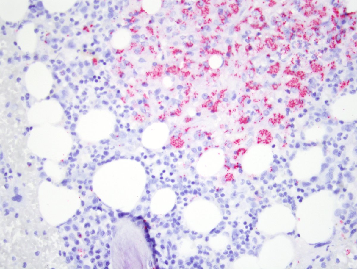 #hemepath Bone marrow - HIV/AIDS. M-ai. 1 - H&E, 2- PAS, 3-CD42b (pos in Mai), 4- mycobacteria IHC