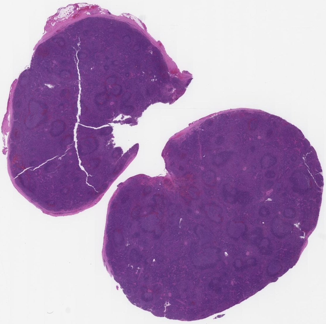 SibaElHussein's tweet image. Kaposi sarcoma herpesvirus/human herpesvirus 8 (KSHV/HHV8)-associated multicentric Castleman disease (KSHV/HHV8-MCD) is a lymphoproliferative disorder with:

🩸 idiopathic multicentric Castleman disease-like morphology (Figure 1 below)
🩸 KSHV/HHV8-infected plasmablasts (Figure 2…