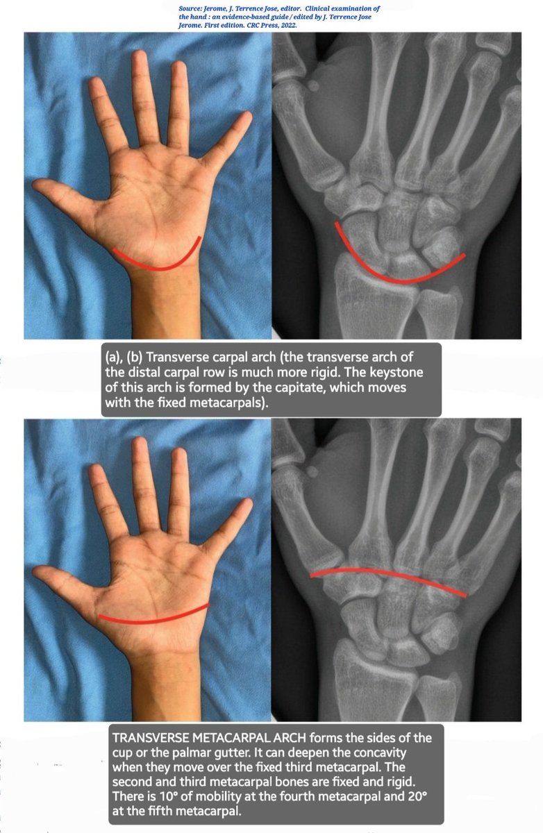 OBandarchi's tweet photo. ✔️Transverse CARPAL arch
(transverse arch of distal carpal row is much more rigid. The keystone of this arch is formed by capitate, which moves with the fixed metacarpals.

✔️Transverse METACARPAL arch
forms sides of the cup or palmar gutter

♦️Nice comparison,surface anatomy.. https://t.co/RtCZIyML5T