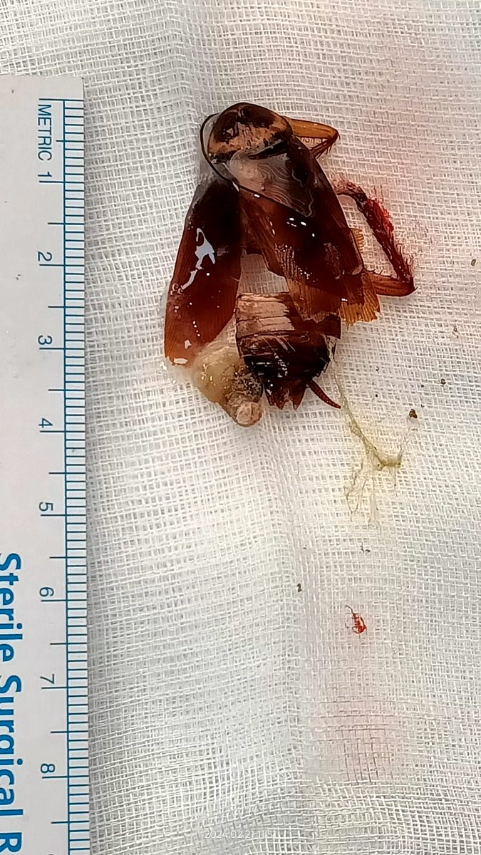 Bronchio-roach;  An unexpected intruder in a bronchus through a tracheostomy

 (credit- WA forward)