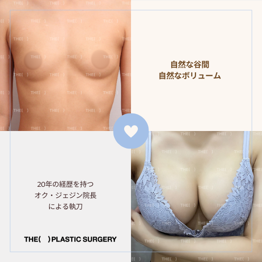 JapanTheps's tweet photo. #THE豊胸

(💙)患者さんレビュー
2ヶ月しか経っていないのに、谷間も自然でボリューム大きさも全てが満足です！
オク院長を信じて手術してよかった😊

※照明により肌の色が違って見えますが同一人物です。

お問い合わせはこちら⏬
https://t.co/g20O4r25aQ

#韓国 #THE美容外科 #ザ美容外科 #豊胸 #胸整形 #渡韓整形 #モティバ #メンター