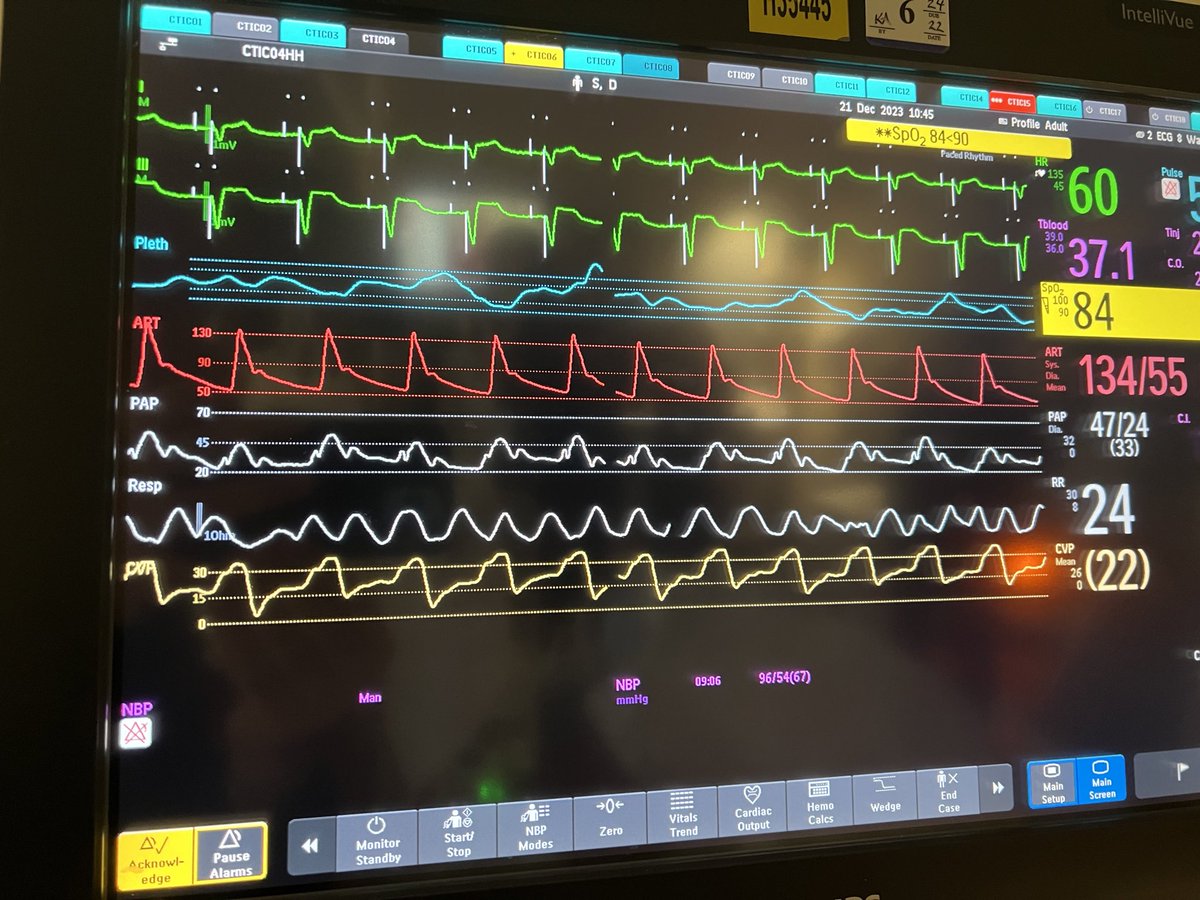 RN paged because cvp waveform “yellow” looks weird.

After confirming that your swan is not too deep, this is a ventricularized CVP waveform in a patient with torrential TR #revivetheswan