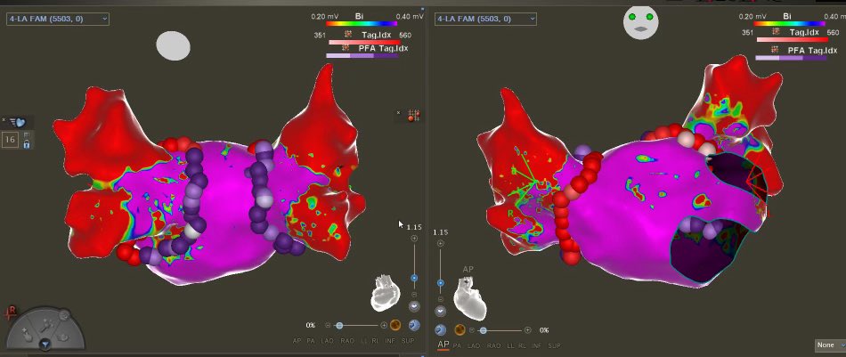 Divyang Patel (@divyangrpatel) on Twitter photo Exciting to work with @BiosenseWebster to start smartpulse paf clinical trial using dual energy thermocool smart touch sf catheter with trupulse generator to advance the field and help our patients <a href="/sentarahealth/">Sentara Health</a>. Thank you to patients, team, and study sponsor @BiosenseWebster. Exciting to work with @BiosenseWebster to start smartpulse paf clinical trial using dual energy thermocool smart touch sf catheter with trupulse generator to advance the field and help our patients <a href="/sentarahealth/">Sentara Health</a>. Thank you to patients, team, and study sponsor @BiosenseWebster.