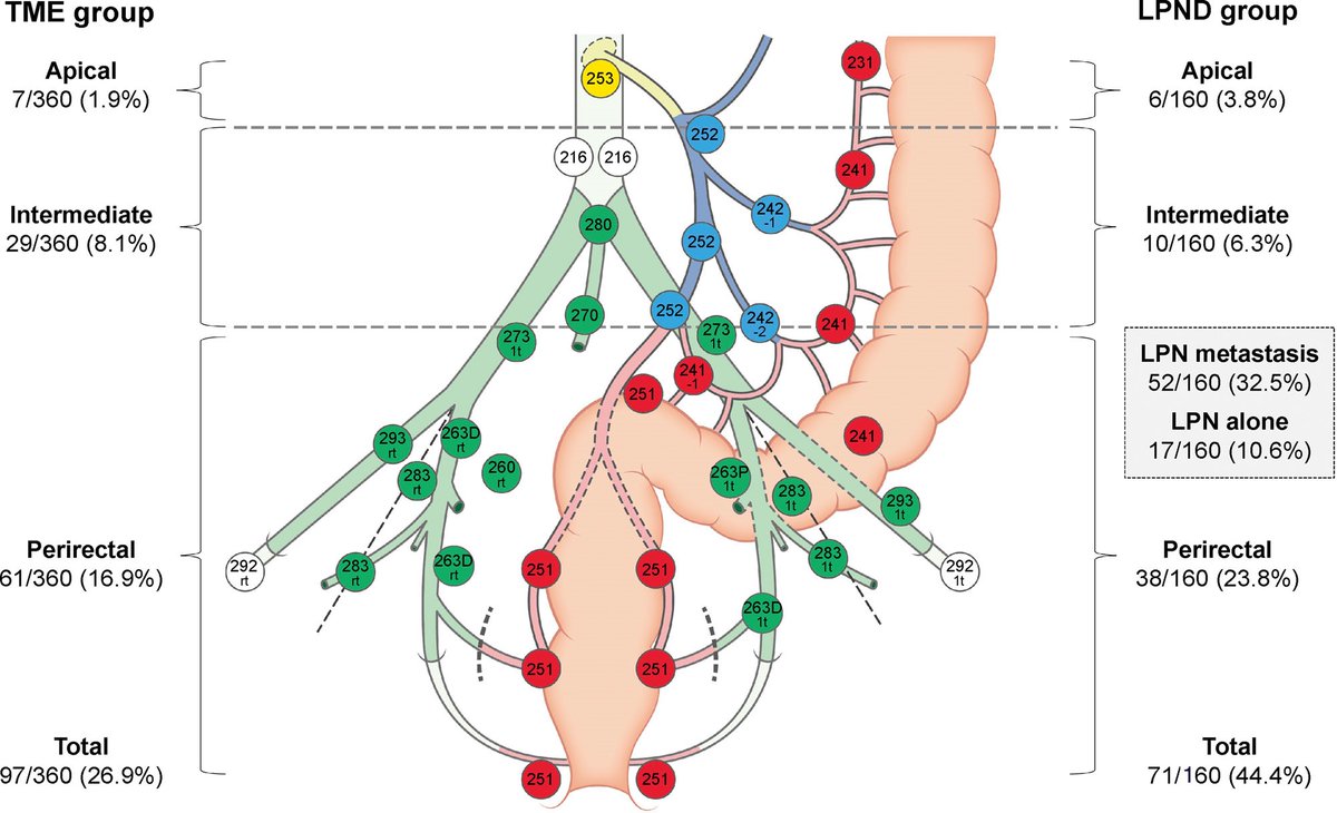Mid/low rectal cancer pts w/ clinical T3/T4 tumors or threatened/involved mesorectal fascia on MRI receiving preop neoadjuvant chemo XRT &amp; subsequent TME with or without lateral pelvic node dissection dep. on pre-treatment MRI LT - survival difference? bit.ly/49sawHg