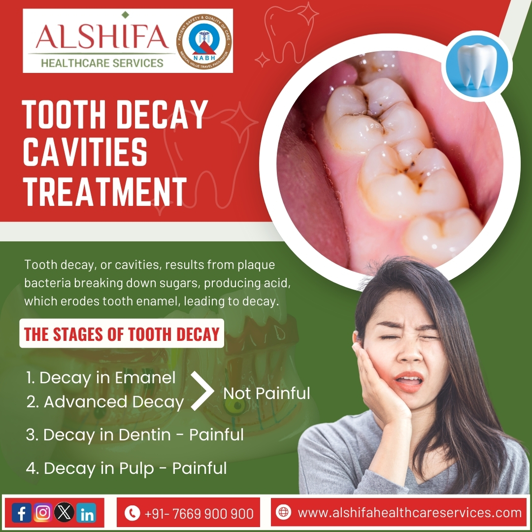 #ToothDecay, or cavities, happens when acid from plaque bacteria eats away at tooth enamel. Not brushing enough, eating too much sugar, and bacteria can make it worse. Brushing, flossing, and seeing the dentist regularly can help stop it. 

#ToothDecay #toothpain #medicaltourism