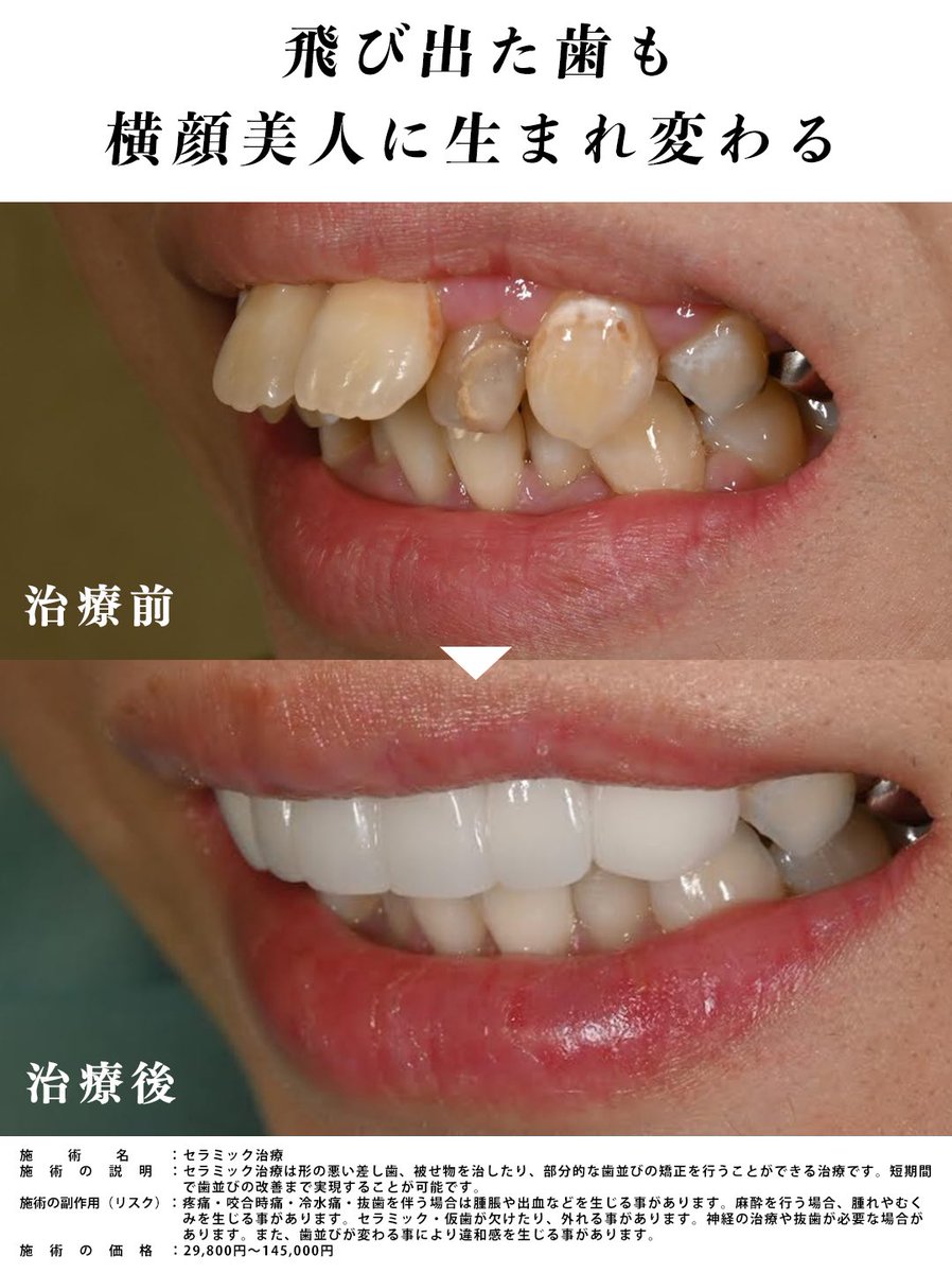 sbc_dental_jun's tweet photo. 出っ歯の症例はマウスピース矯正でも改善させることが可能ですが、セラミック治療なら最短即日仮歯へ。
横から見てもここまで変わります。

#セラミック治療
#マウスピース矯正 https://t.co/cyu1dfNoaR