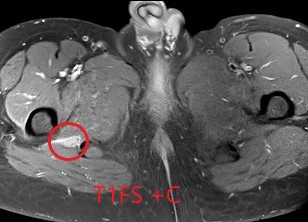 Sciatic neuropathy/inflammation
RT sciatic nerve (red circles and arrows) showing diffuse thickening, loss of its fascicular pattern, high signal  on  T2 and PD  w post contrast enhancement.
Normal LT sciatic nerve (yellow circle and arrows)
#radiology #msk #radtwitter #radEd