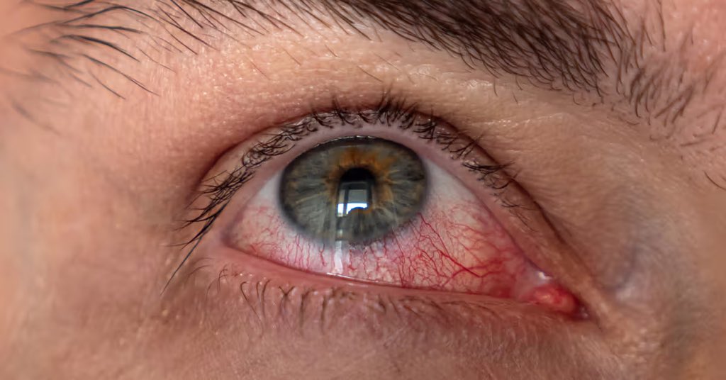 GabrielAgbeshie's tweet photo. DRY EYE SYNDROME

What is it and how can it be managed? 👇 https://t.co/qXLnIyXu3b