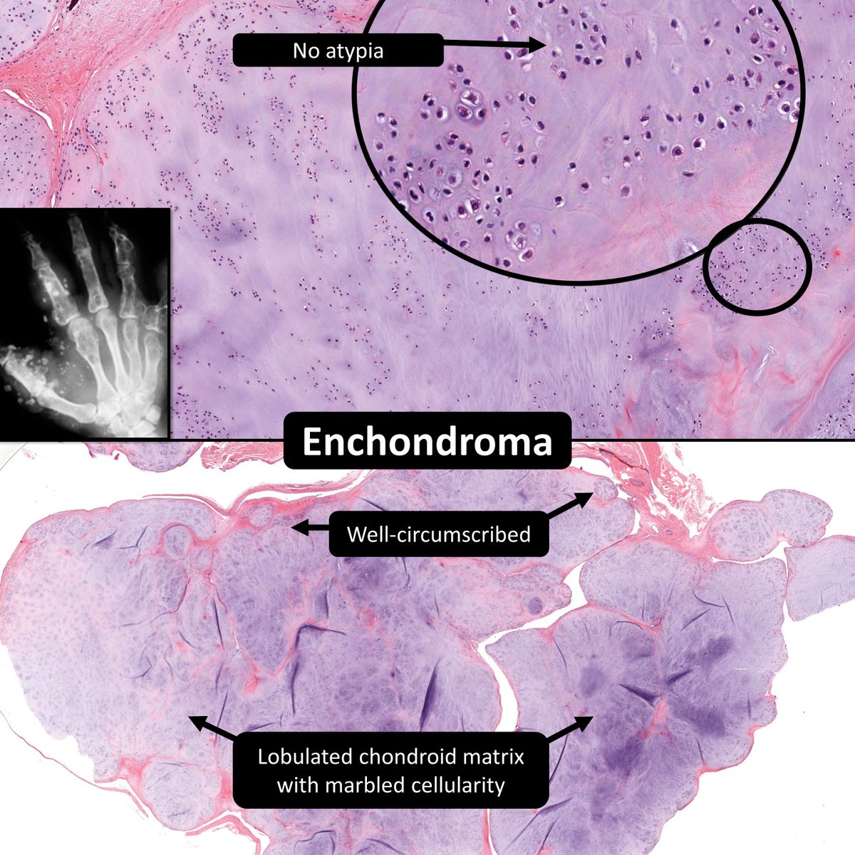 Chondrosarcoma & Osteosarcoma: extremely rare in hands & feet ...