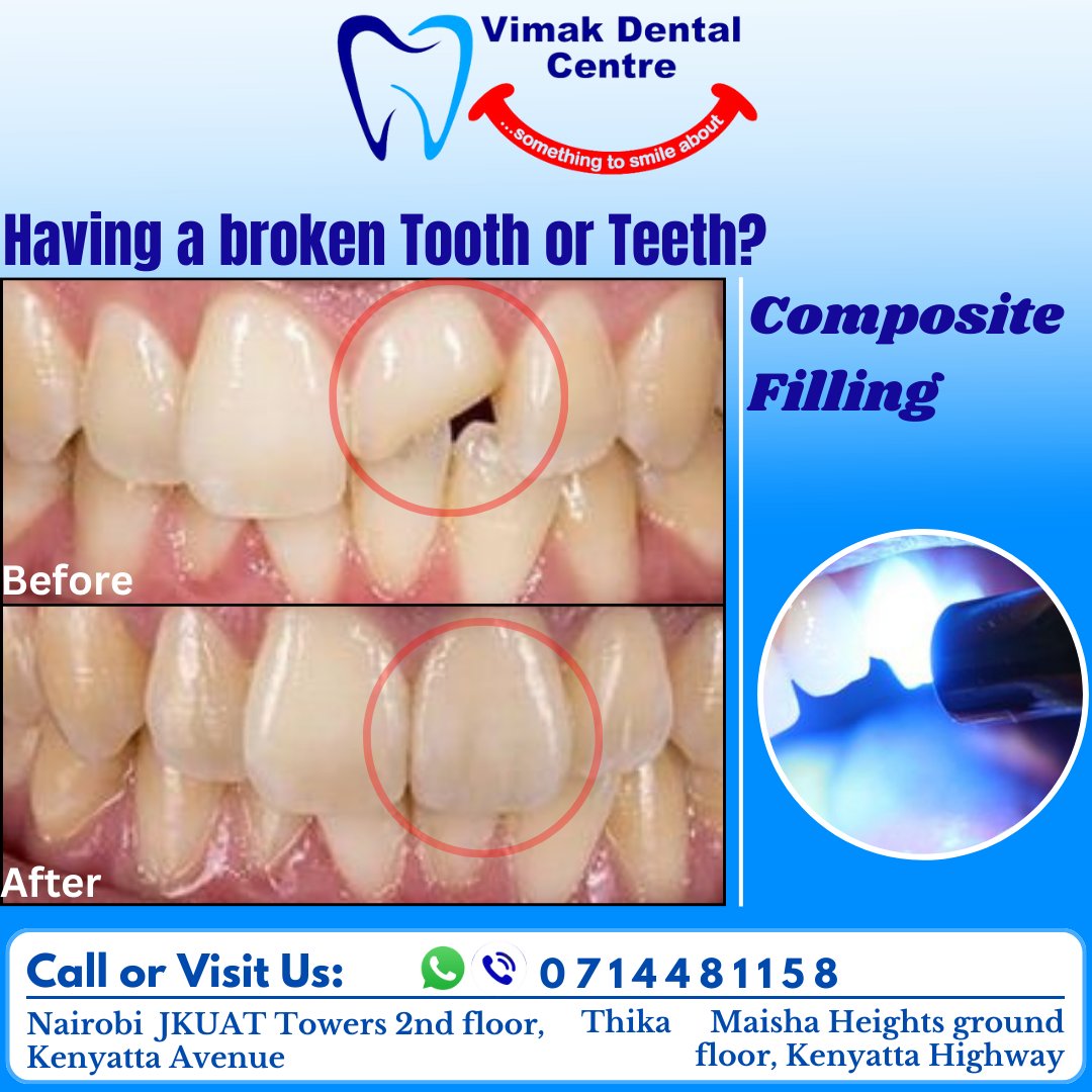 Get all of your fractured teeth restored with a uniform, smooth composite filling to maintain the aesthetic attractiveness of your smile.
vimakdentalcentre.co.ke
#vimakdentalcentre
#vimakdentalservices
1 USD