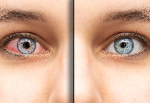 Are you affected by #dryeyes? Learn more about this often underestimated ocular condition and its therapeutic treatment strategies!
onpointmedicals.at/blog/understan…
#bloodproducts #DED #bloodbank #bloodtransfusion #bloodsafety #serumtears #serumeyedrops #dryeyedisease #SED #ophthalmology