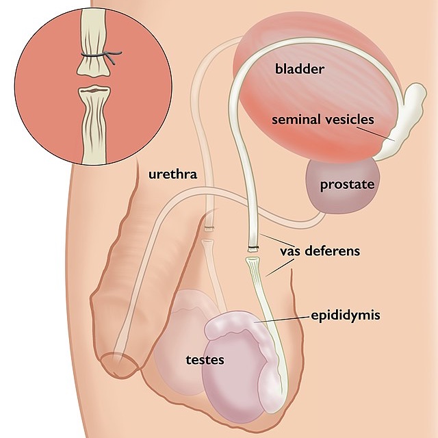 IJIR: Your Sexual Medicine Journal (@yoursexmedjour) on Twitter photo Uncovering the interhospital price variations for #vasectomy in the United States 👉 rdcu.be/dziIv
<a href="/mortach_sherry/">Sherry Mortach</a> <a href="/NickSellke/">Nick Sellke</a> @Kimberly__Tay <a href="/RamyAbouGhayda/">Ramy Abou Ghayda</a> <a href="/AramLoeb/">Aram Loeb</a> <a href="/DrNannanT/">Dr. Nannan Thirumavalavan</a> <a href="/CaseUrology/">University Hospitals Urology Institute</a> <a href="/cwru/">Case Western Reserve</a> <a href="/CleClinicUro/">Cleveland Clinic Urology</a> Uncovering the interhospital price variations for #vasectomy in the United States 👉 rdcu.be/dziIv
<a href="/mortach_sherry/">Sherry Mortach</a> <a href="/NickSellke/">Nick Sellke</a> @Kimberly__Tay <a href="/RamyAbouGhayda/">Ramy Abou Ghayda</a> <a href="/AramLoeb/">Aram Loeb</a> <a href="/DrNannanT/">Dr. Nannan Thirumavalavan</a> <a href="/CaseUrology/">University Hospitals Urology Institute</a> <a href="/cwru/">Case Western Reserve</a> <a href="/CleClinicUro/">Cleveland Clinic Urology</a>