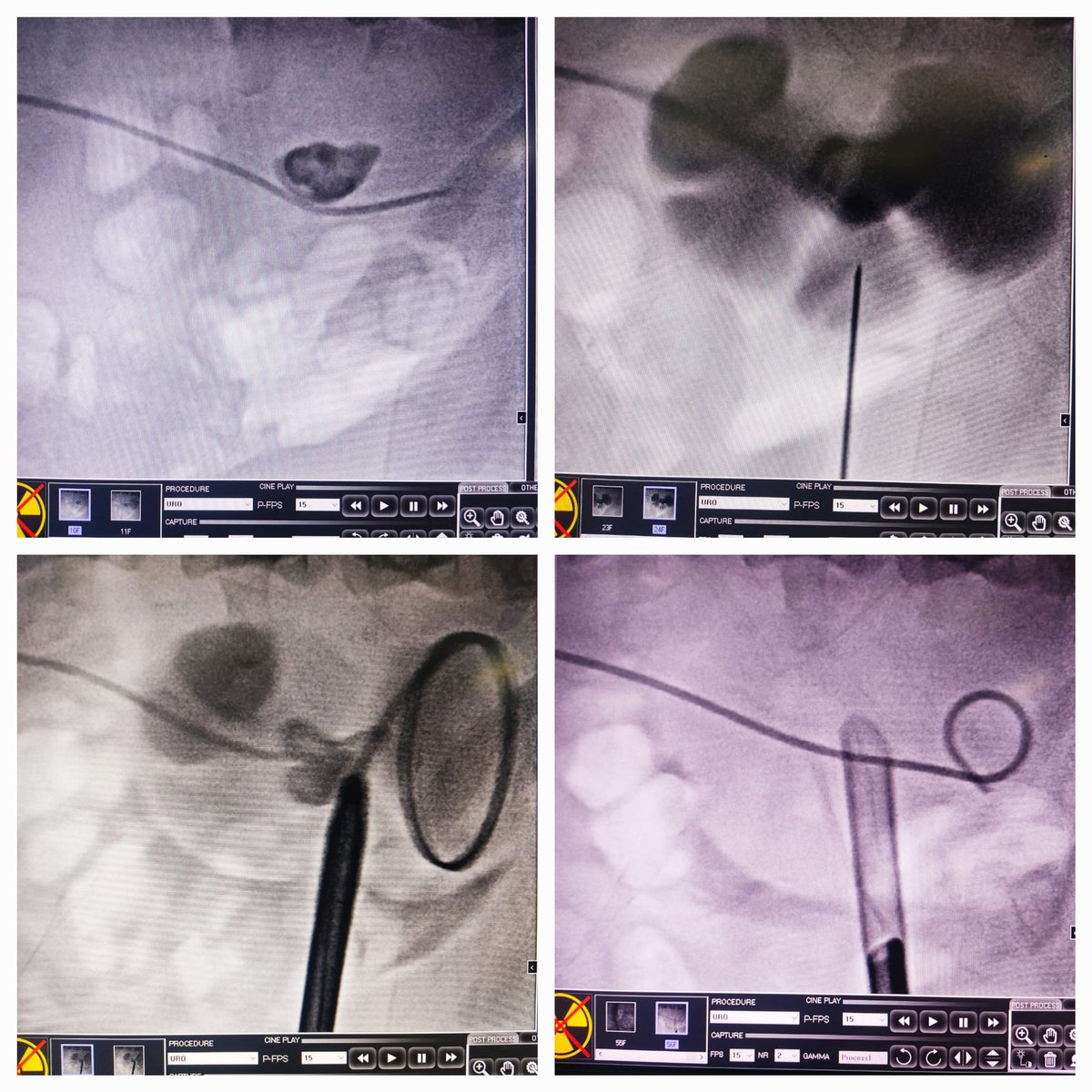 Prone PCNL; when to do anterior calyx puncture. One of the rare scenarios of malrotated kidney needing Ant. Calyx puncture for access. @ArunkumarDr @DocGauhar @drkemalsarica @DrParimalGharia @DrVCMohan @Endo_Society @YouthUSI @abhisingh82 @drkarthicknagan @mohamed92902484