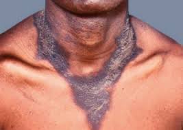 okohtochukwuso1's tweet image. 👨‍⚕️ #MedicalMCQ Alert! 🩺

A 45-year-old man presents with the following skin changes. 

What #relevant_history will you take to diagnose this condition?

A) H/o dietary pattern, dementia, diarrhea
B) Dietary history
C) Dementia
D) Depression
#SkinChanges #MedicalHistory
