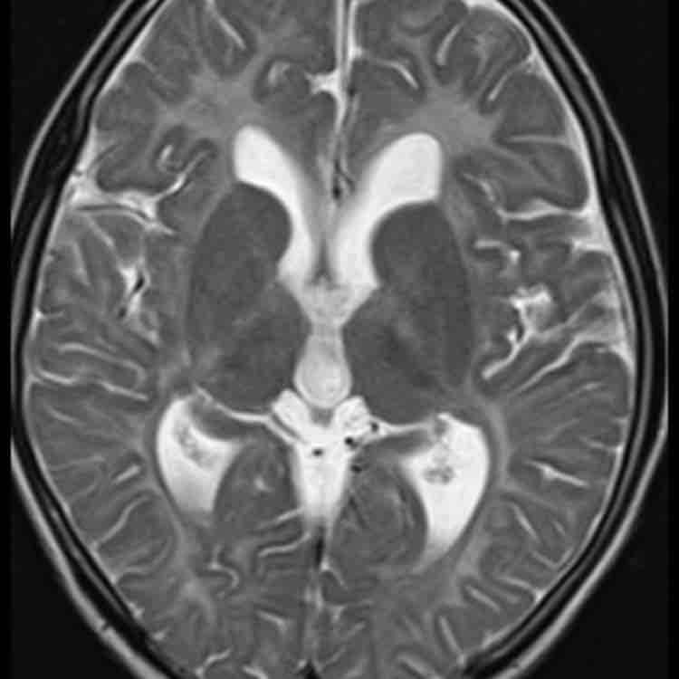 TheAJNR's tweet photo. #AJNRcow >> February 22, 2024 >> An 11-year-old boy presents with unsteadiness in walking for the past 5 years, associated with gradually progressive hand tremulousness, slurring of speech, and cognitive decline. View the case: https://t.co/AxcYXdzgf3 https://t.co/ElgASektRB