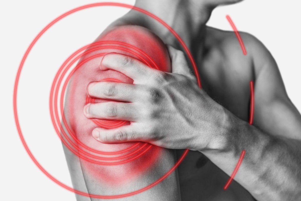 rdcu.be/dzhnm Happy to share that our study protocol for PASE trial is published - we are asking whether we should allow or avoid pain during shoulder rehabilitation exercises for patients with chronic rotator cuff tendinopathy? @Cph_Rehab @SPMagnuss
