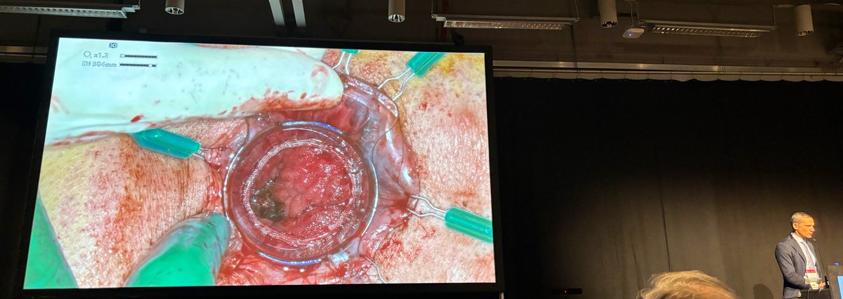 MiguelCunhaSurg's tweet photo. #ECCO2024 #ECCO24 

✅Pouch Surgery 

@AntoninoSpin showed a brilliant and precise way to perform: 

⚠️TTSS pouch anastomosis IPAA⚠️

👉Tips, tricks &amp; Advantages 

👏👏👏

@escp_tweets @YouESCP @caterina_foppa @CRHumanitas @mic_carvello @eloiespin https://t.co/WfDzgUbf33
