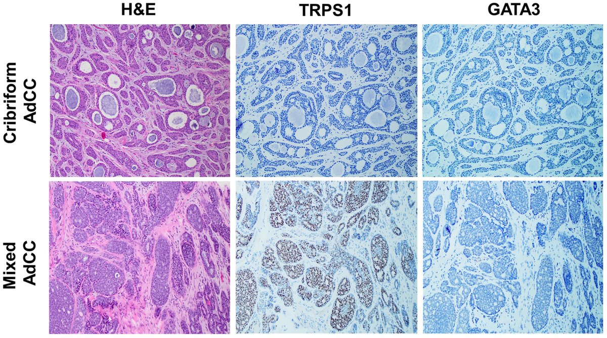 Very excited to share our paper (comparative Evaluation of TRPS1 and GATA3 in salivary gland tumor) just published in @humpathol 
#pathology #PathTwitter #breastpath #ENTpath #pathresidents #BreastPatholog1 
@ColumbiaPath @Columbia @MDAndersonNews @TheISBP
sciencedirect.com/science/articl…