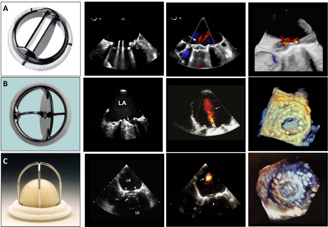 Have you read our 2024 #guideline, 'Guidelines for the Evaluation of Prosthetic Valve Function With Cardiovascular Imaging?' Check it out: bit.ly/3vosxI5 It was made in collaboration with @SCMRorg and the @Heart_SCCT! #ValveDiseaseDay #valvedisease