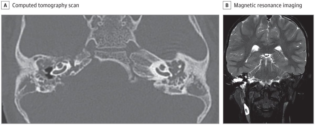 Take the Clinical Challenge

25-month-old child with unilateral hearing loss was referred to a pediatric ear, nose, and throat surgeon. Clinical findings suggested unilateral right middle ear effusion associated with ipsilateral conductive hearing loss. (1/3)