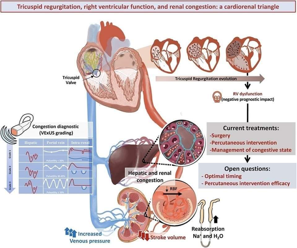 🔴 Tricuspid regurgitation, right ventricular function, and renal congestion: a cardiorenal triangle #2023review #openaccess 

frontiersin.org/articles/10.33…
#cardiology #CardioTwitter #CardioEd