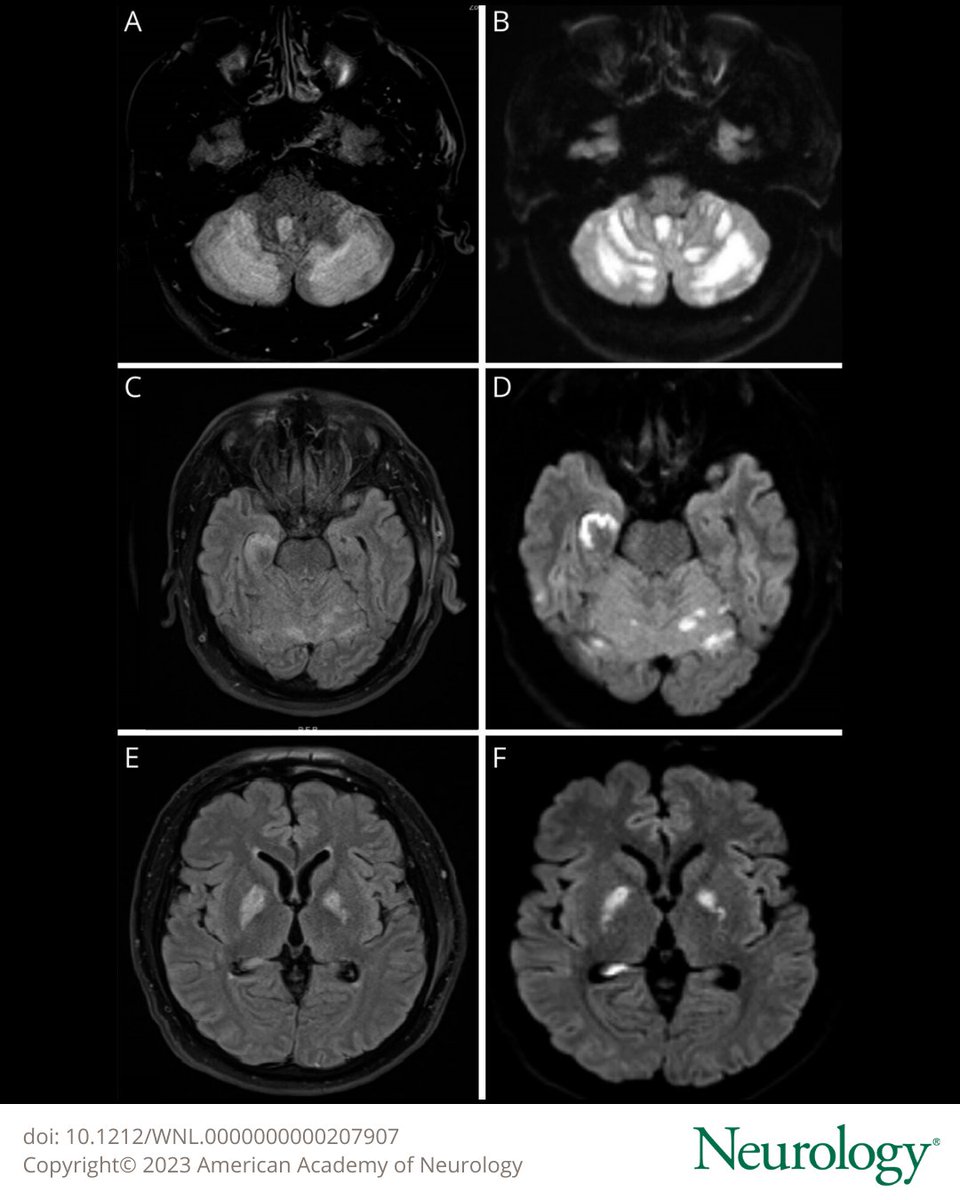 A 44‐year‐old man with a history of polysubstance use disorder presents with coma. Brain MRI demonstrates diffuse cerebellar edema on FLAIR and multiple foci of restricted diffusion in the cerebellar, hippocampus, and basal ganglia. #NeurologyRF 🧵👇