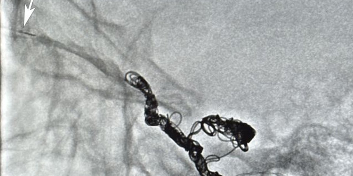 eyewiki's tweet photo. Learn how the orbit can be used to access the #cavernoussinus for treating carotid fistulas. #oculoplastics #ophthalmology https://t.co/vMoWPWM2Jw https://t.co/bUGMQXiwGS