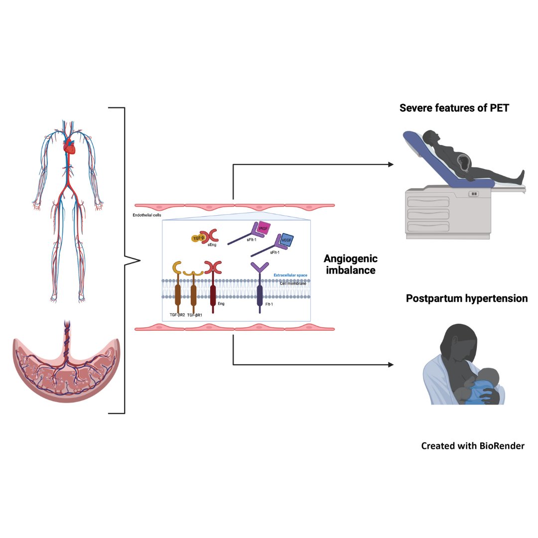 Check out new open-access #UOGJournal article by Giorgione et al. on the correlations of PlGF and sFlt-1 with maternal cardiac indices in women affected by #preeclampsia bit.ly/49jNfYA