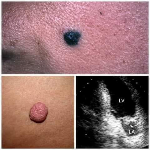 hemo_shk's tweet photo. #myxomas
#lentiginosis
#PPNAD
What is the diagnosis?
What syndrome is associated with mentioned above?
#MEDHM
@IhabFathiSulima https://t.co/ib6RJdJxZw