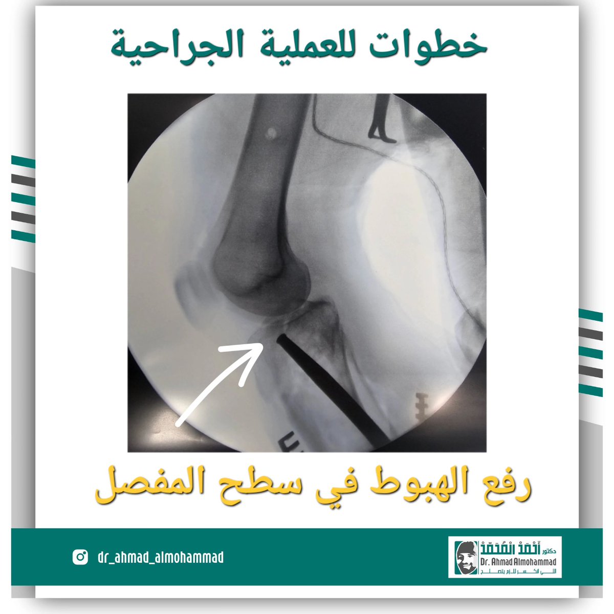 dr_aalmohammad's tweet photo. كسور هضبة الساق من الكسور المعقدة لانها تكون متصلة مع سطح مفصل الركبة 
والهدف من الرئيسي من العملية إرجاع سطح المفصل و تثبيت الكسر
#اللي_انكسر_لازم_يتصلح https://t.co/NwOVtOh3tX