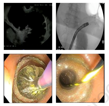 Online now in GIE’s Articles in Press: “Colonicenteric lumen-apposing metal stents: a promising and safe alternative for endoscopic management of small-bowel obstruction” by Shuji Mitsuhashi et al. giejournal.org/article/S0016-… @ShuGI821