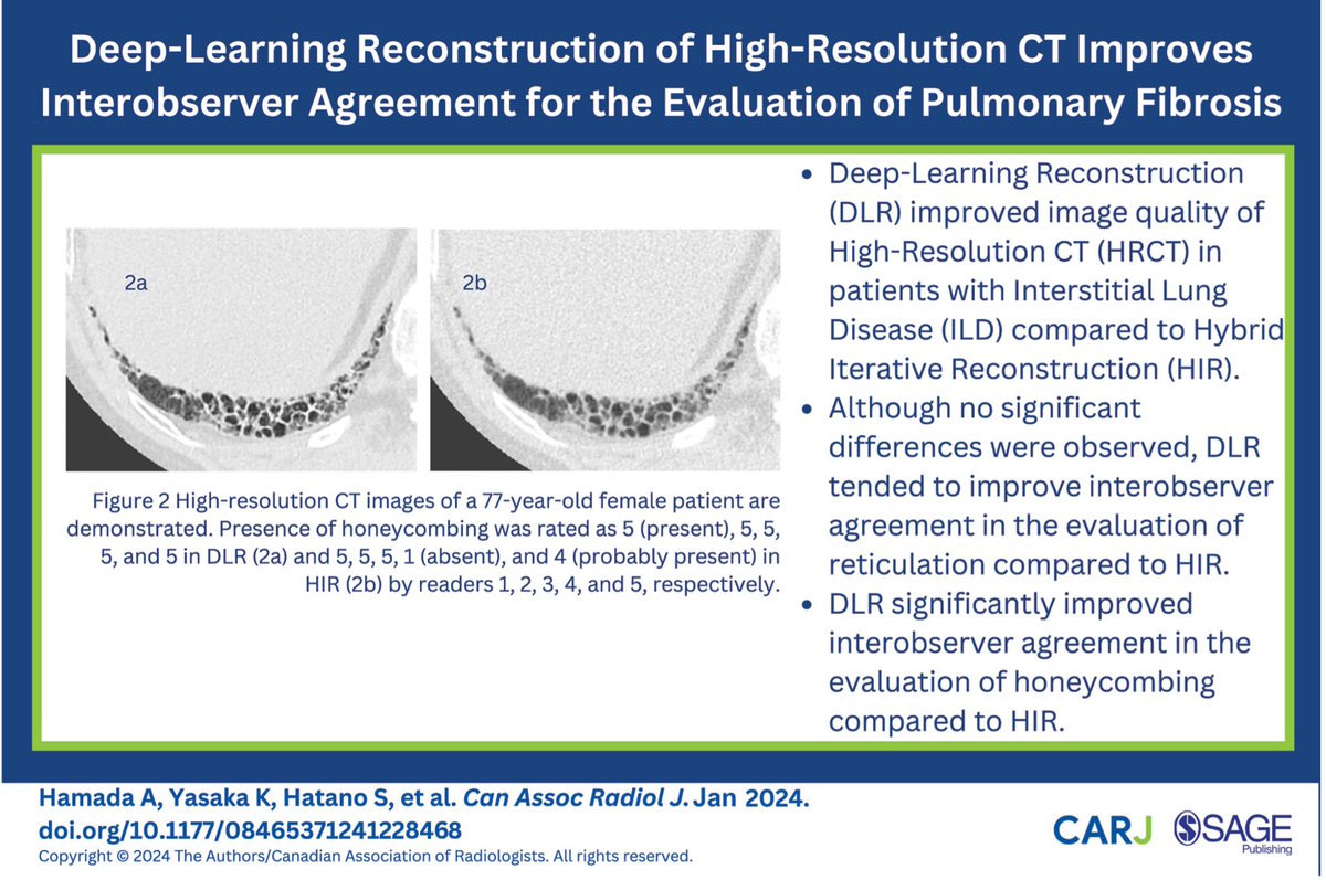 Check out this recently published study which found that deep-learning reconstruction of HRCT improves interobserver agreement for evaluating pulmonary fibrosis: doi.org/10.1177/084653… @CARadiologists @SageJournals #radiology #radres #deeplearning #ai #pulmonaryfibrosis