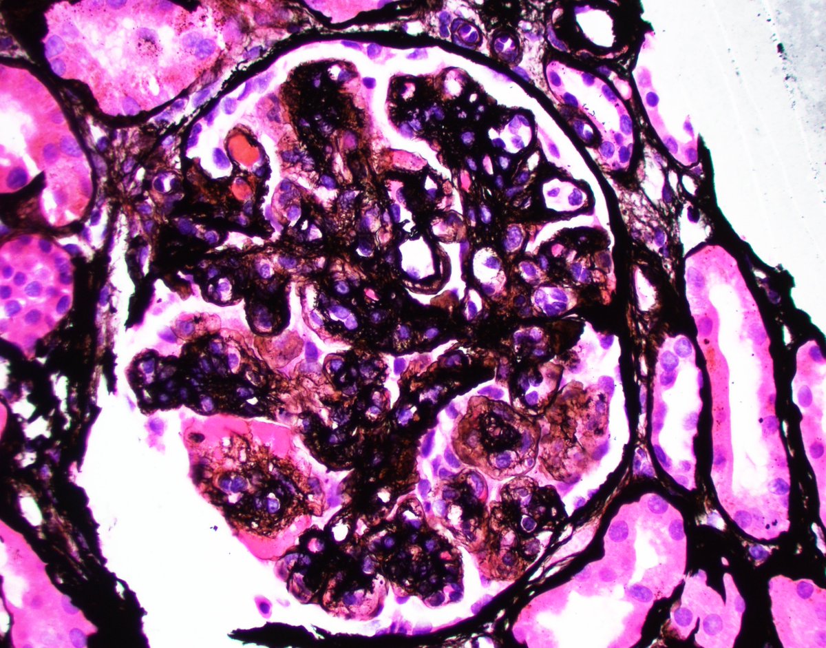 JZRenalPath's tweet photo. A reminder that cryoglobulinemic glomerulonephritis can still occur post-HCV treatment. Biopsy for hematuria, proteinuria, and elevated sCr. Low c3/c4. +cryocrit and RF. #renalpath #pathtwitter https://t.co/0Lq3r6kaW1