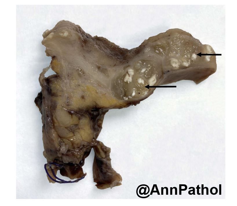 Annpathol's tweet photo. 🇲🇫 Femme de 45 ans suivie pour une maladie de crohn ; résection iléo-colique.
🔬 Diagnostic?
🇬🇧 45 y.o woman w crohn disease; ileocaecal resection.
🔬 Diagnosis?
#pathology #gipath #francophonepath https://t.co/XgUZzsz0pp