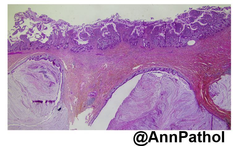 Annpathol's tweet photo. 🇲🇫 Femme de 45 ans suivie pour une maladie de crohn ; résection iléo-colique.
🔬 Diagnostic?
🇬🇧 45 y.o woman w crohn disease; ileocaecal resection.
🔬 Diagnosis?
#pathology #gipath #francophonepath https://t.co/XgUZzsz0pp