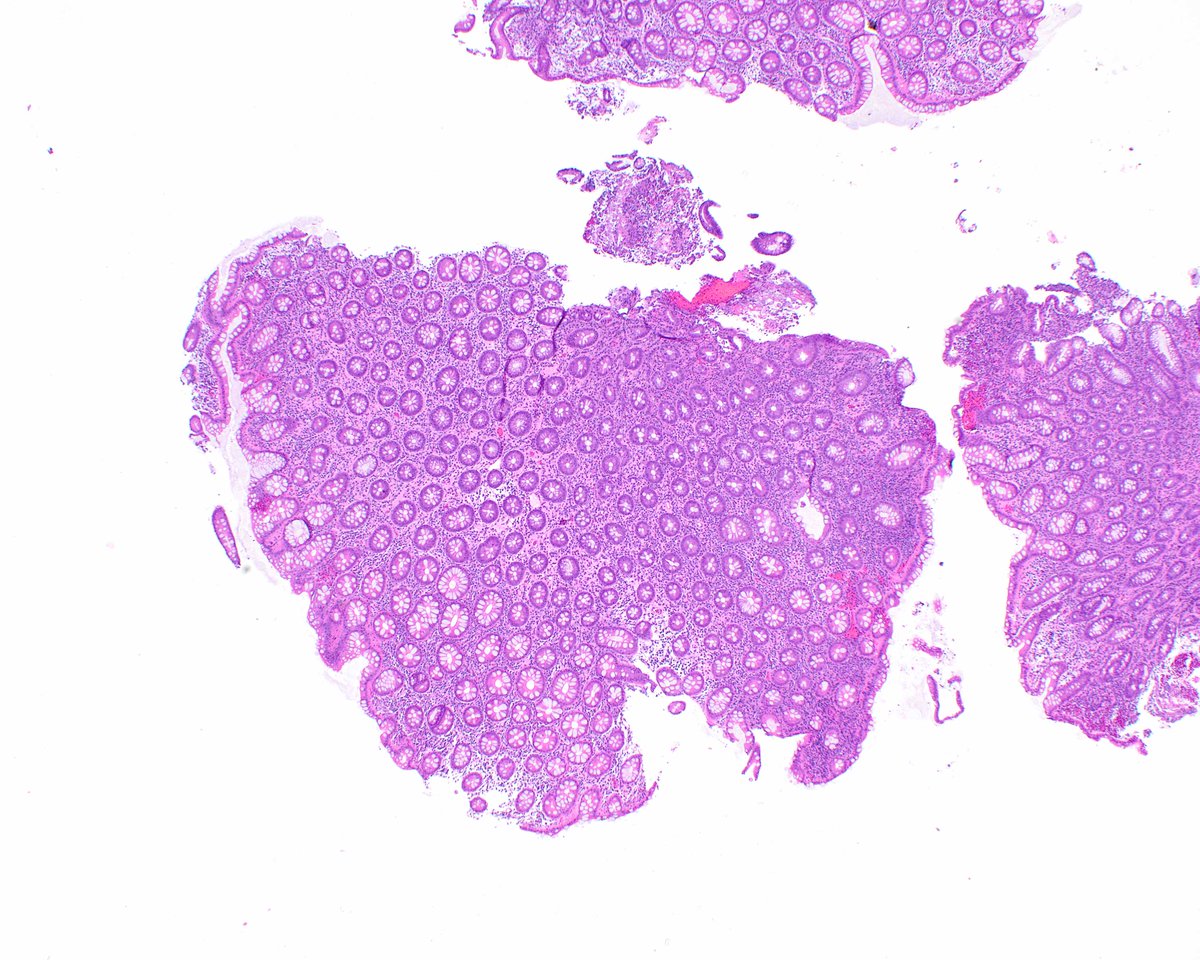 LizMontgomeryMD's tweet image. Today's creature feature is E. histolytica.  Erythrocytes are green in this PAS preparation, which makes it easy to see ingested erythrocytes inside the organisms.  The important thing is to always check in sloughed exudate in injured mucosa. #umiamipath