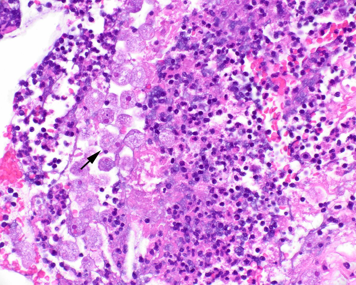 LizMontgomeryMD's tweet image. Today's creature feature is E. histolytica.  Erythrocytes are green in this PAS preparation, which makes it easy to see ingested erythrocytes inside the organisms.  The important thing is to always check in sloughed exudate in injured mucosa. #umiamipath