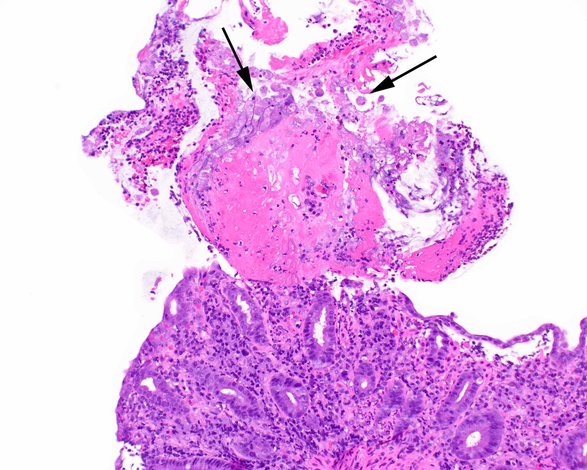 LizMontgomeryMD's tweet image. Today's creature feature is E. histolytica.  Erythrocytes are green in this PAS preparation, which makes it easy to see ingested erythrocytes inside the organisms.  The important thing is to always check in sloughed exudate in injured mucosa. #umiamipath