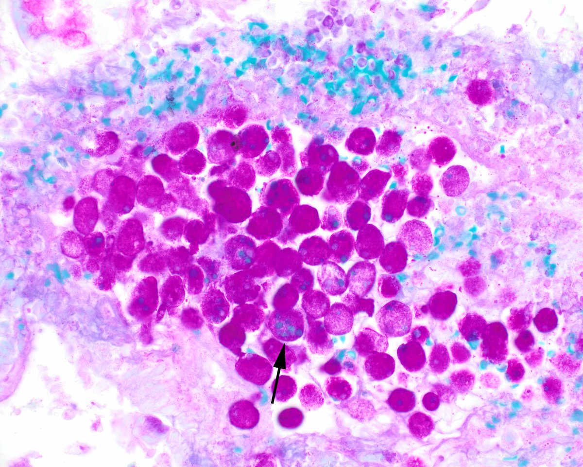 LizMontgomeryMD's tweet image. Today's creature feature is E. histolytica.  Erythrocytes are green in this PAS preparation, which makes it easy to see ingested erythrocytes inside the organisms.  The important thing is to always check in sloughed exudate in injured mucosa. #umiamipath